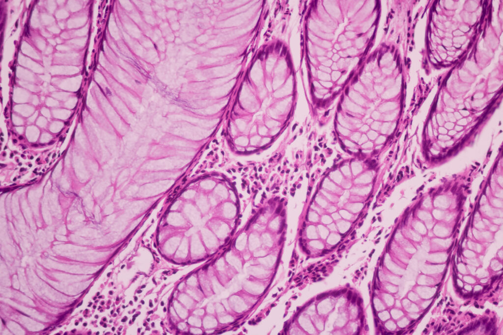 Adenonocarcinoma from human breast cancer, ductal cell carcinoma, tissue section by H and E stain